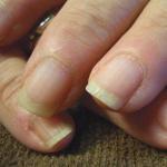 Причины расслоения ногтей на руках