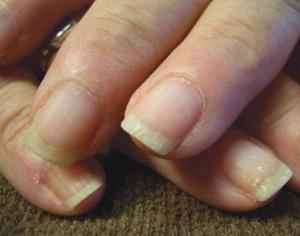 Причины расслоения ногтей на руках